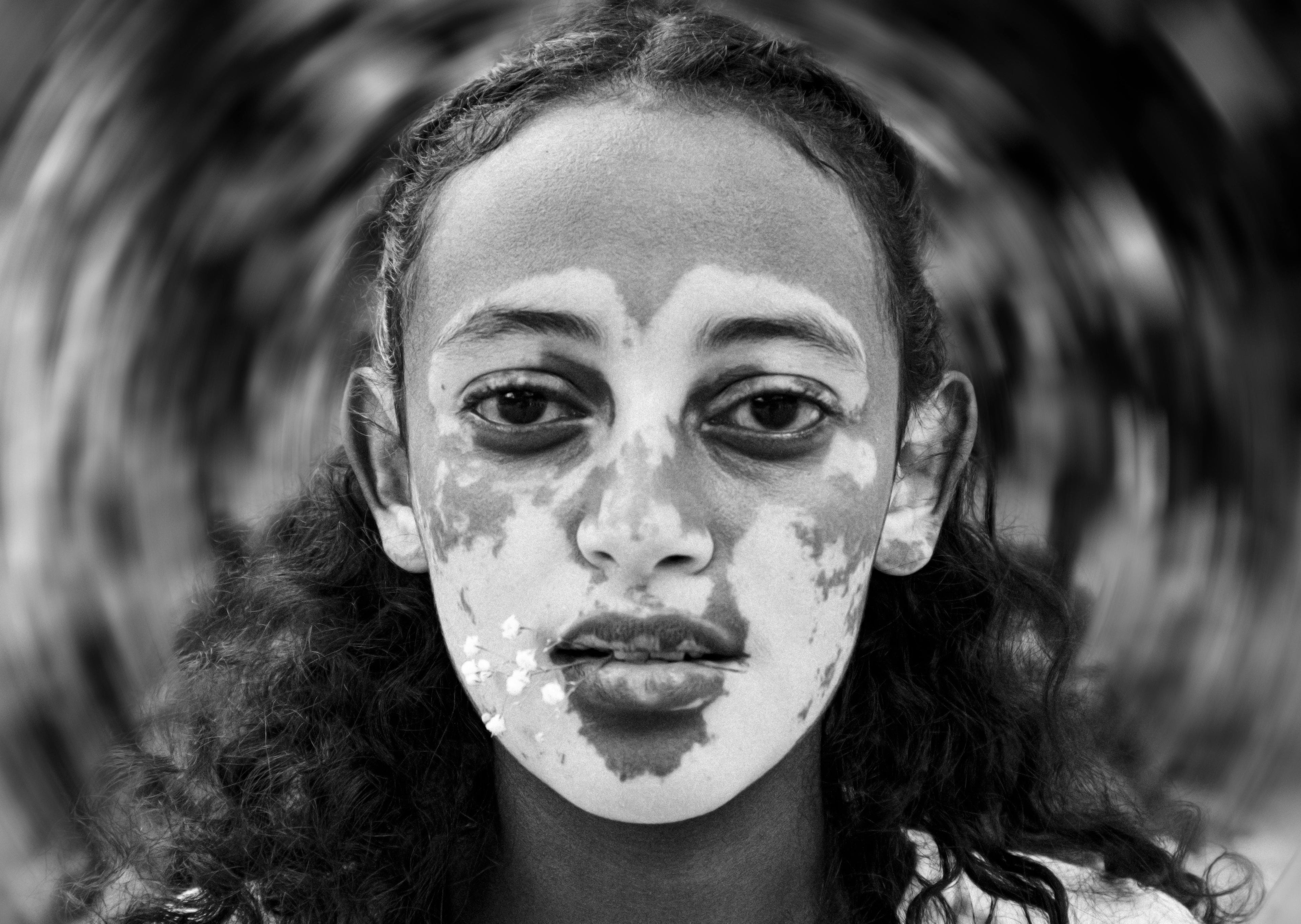 A girl with Vitiligo white patches on her skin